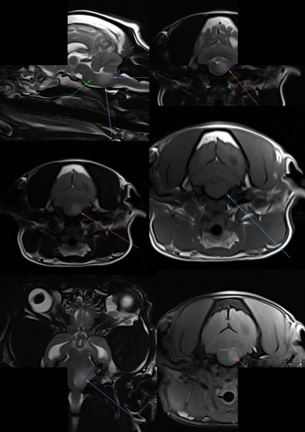 MRI — meningoencephalitis