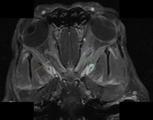 MRI — optic neuritis