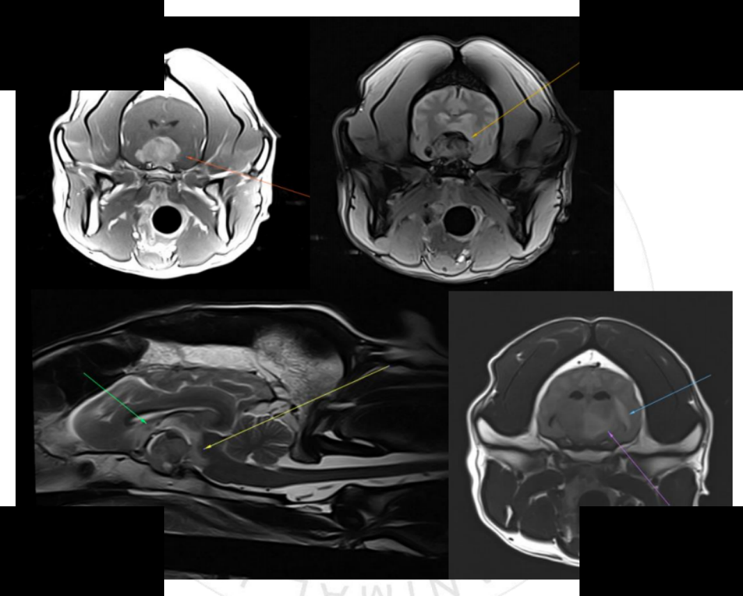 MRI — pituitary tumor